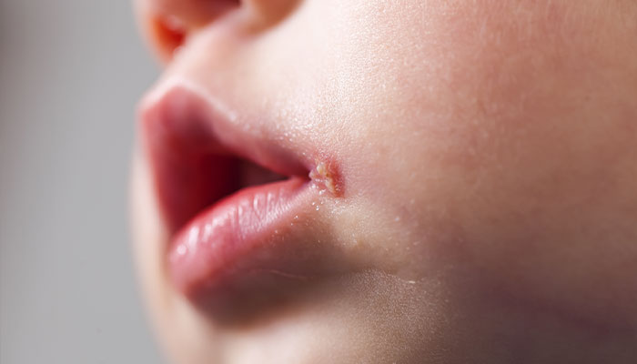 Herpes virus: nguyên nhân mắc bệnh và cách điều trị